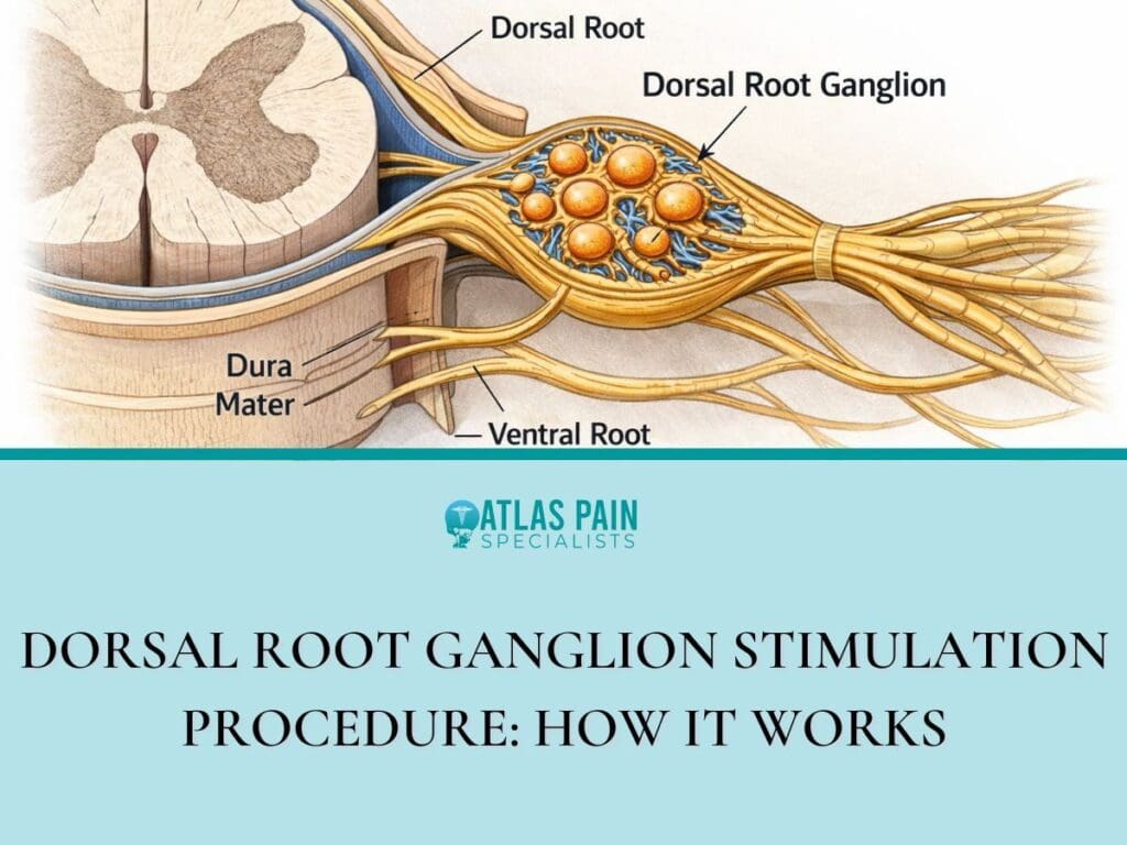 Dorsal Root Ganglion Stimulation Procedure: How It Works|Infographic illustration on Understanding the Dorsal Root Ganglion in Pain Management